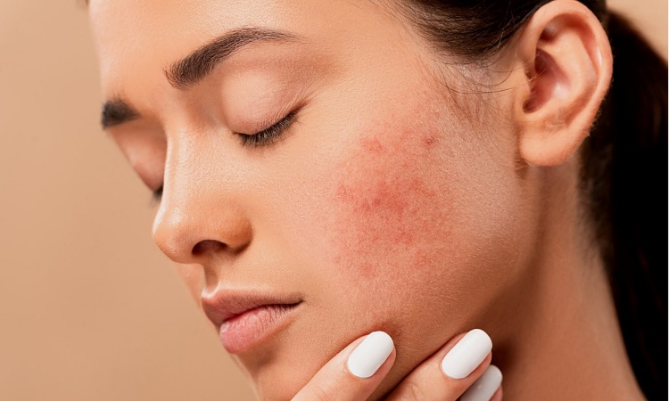 acne-treatment
