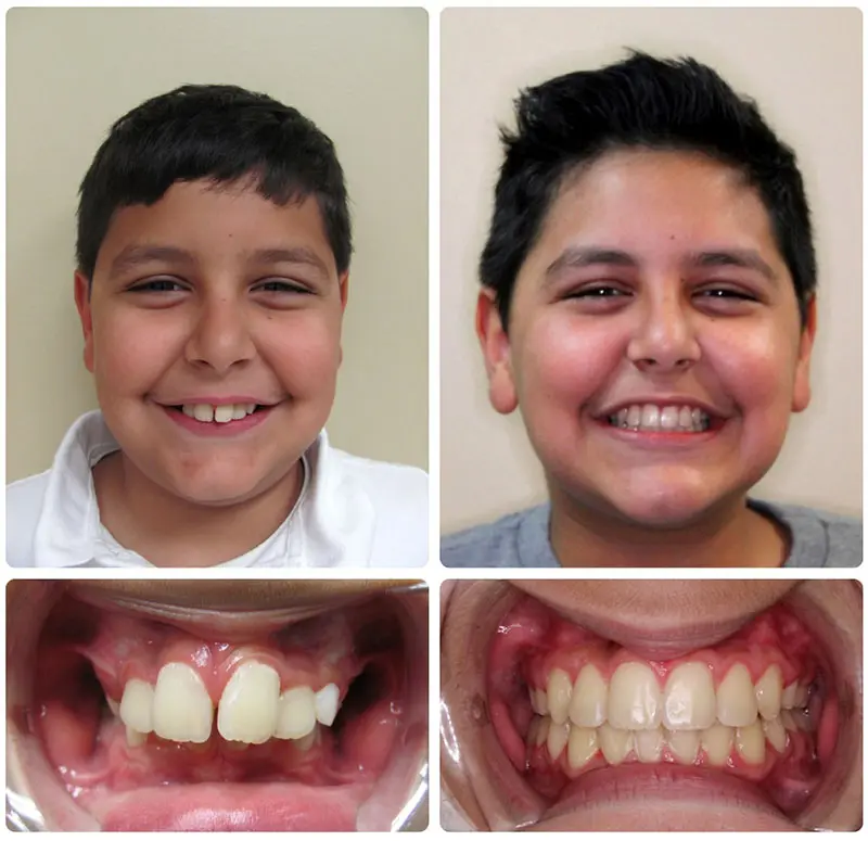 beforeandafterkids
